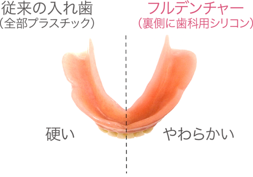 従来の入れ歯とフルデンチャーの違い。