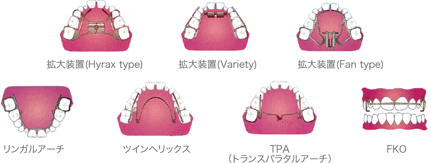 様々なタイプの矯正装置。