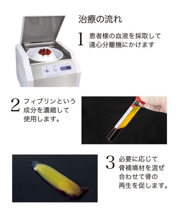 治療の流れ。１．患者様の血液を採取して遠心分離機にかけます。２．フィブリンという成分を濃縮して使用します。３．必要に応じて骨補填材を混ぜ合わせて骨の再生を促します。
