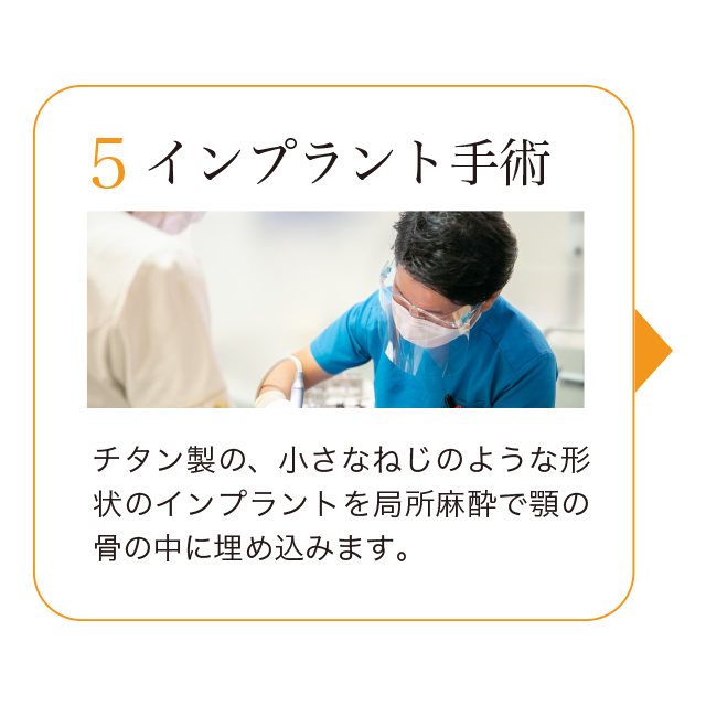 5.インプラント手術。チタン製の、小さなねじのような形状のインプラントを局所麻酔で顎の骨の中に埋め込みます。