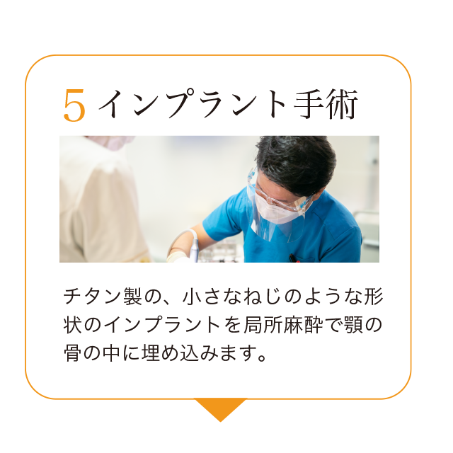 5.インプラント手術。チタン製の、小さなねじのような形状のインプラントを局所麻酔で顎の骨の中に埋め込みます。