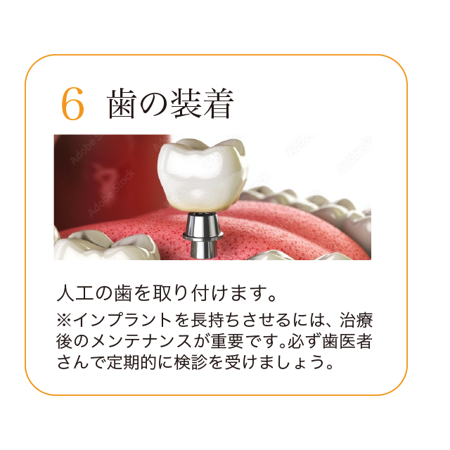 6.歯の装着。人工の歯を取り付けます。※インプラントを長持ちさせるには、治療後のメンテナンスが重要です。必ず歯医者さんで定期的に検診を受けましょう。